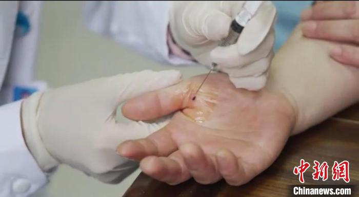 嘉善群眾體驗小針刀?！〖紊平y(tǒng)戰(zhàn) 供圖